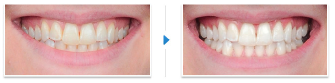 Teeth-Whitening-Norman-OK.png